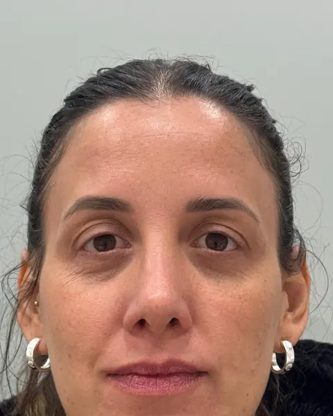 Antes: rosto de frente