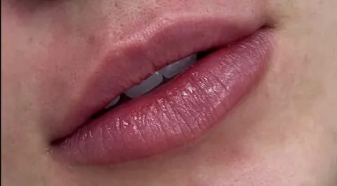 Lábios depois do preenchimento labial, com contorno natural