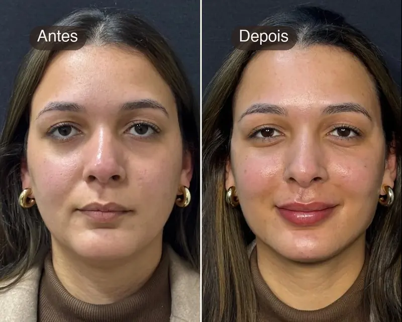 Antes e depois de um tratamento full face, de frente