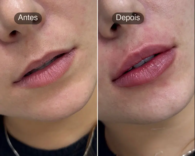 Antes e depois de preenchimento labial, em close dos lábios