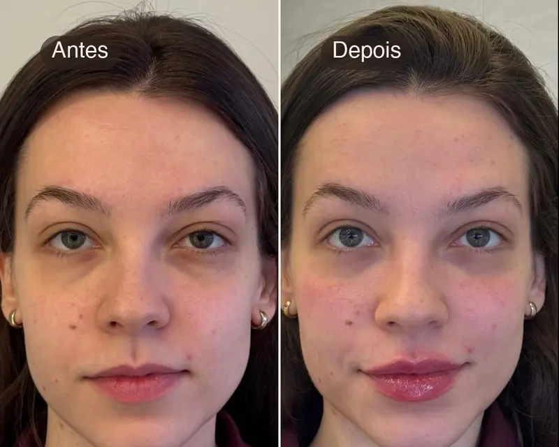 Antes e depois do caso de assimetria facial, de frente