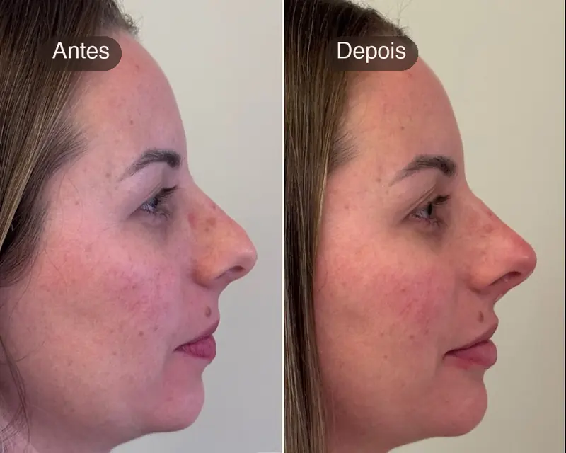 Antes e depois de perfil, com queixo e mandíbula mais definidos